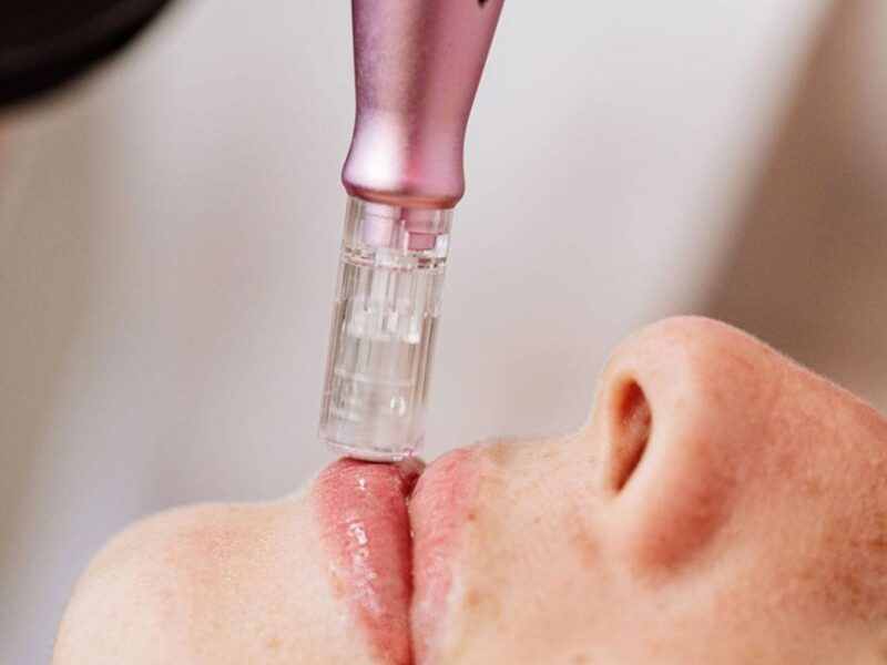 dermapen tenerife