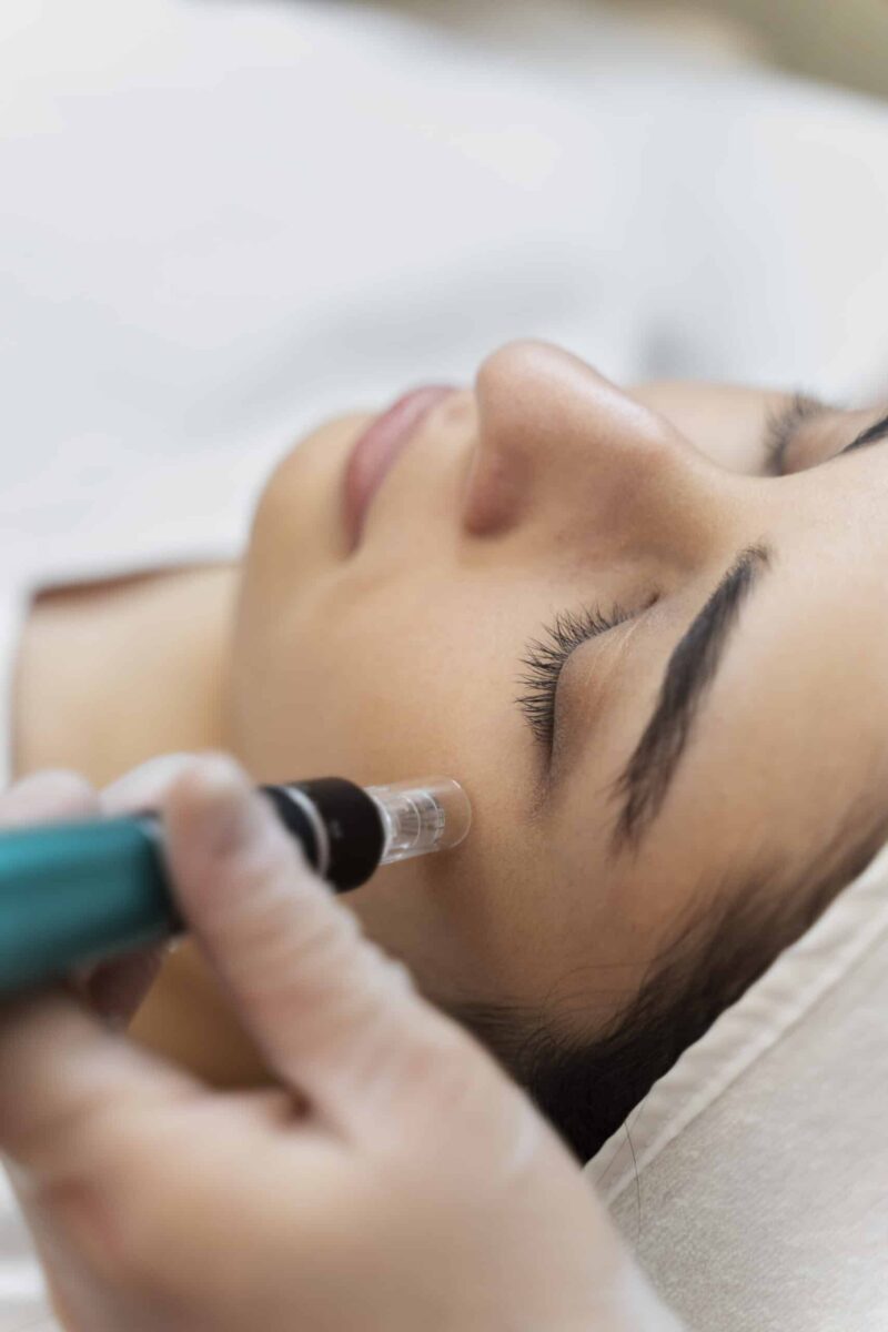 dermapen tenerife