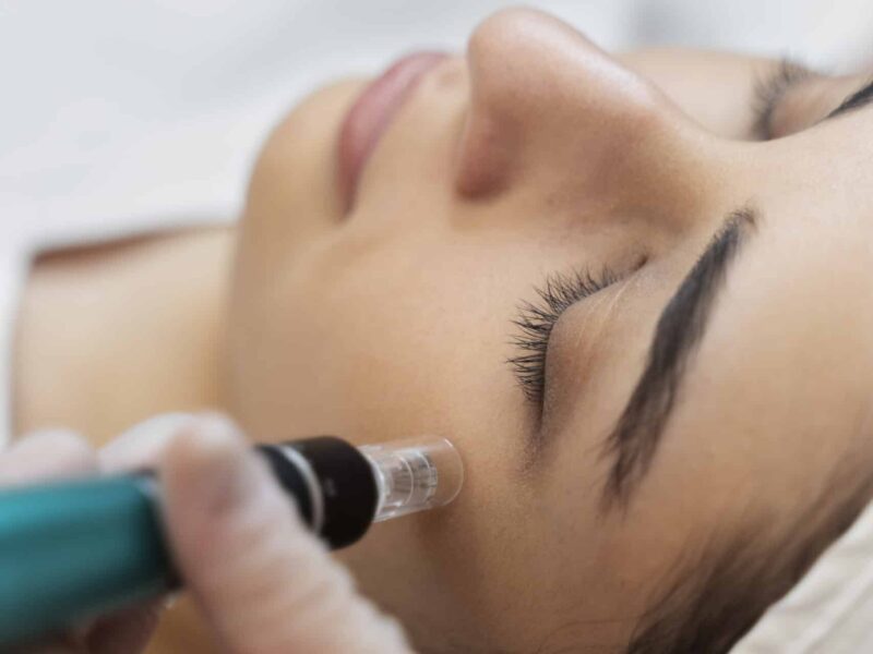 dermapen tenerife