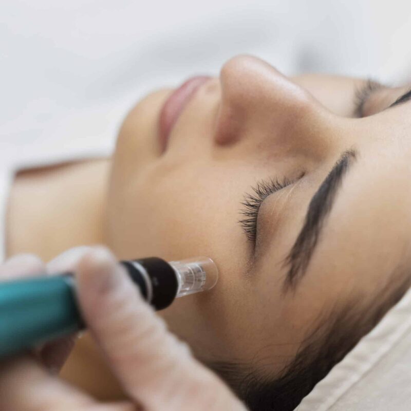 dermapen tenerife